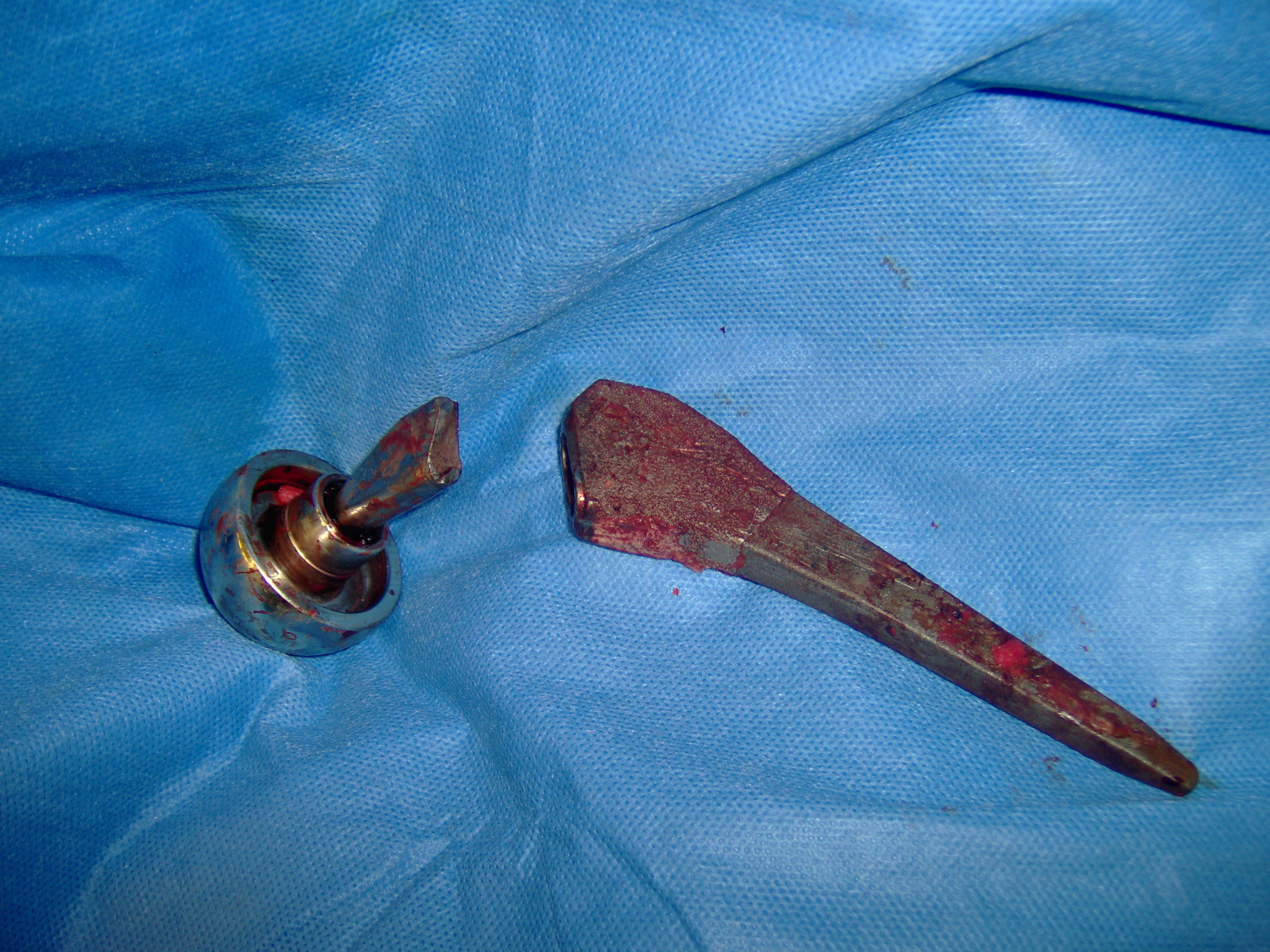 Picture of the fractured metallic prosthesis