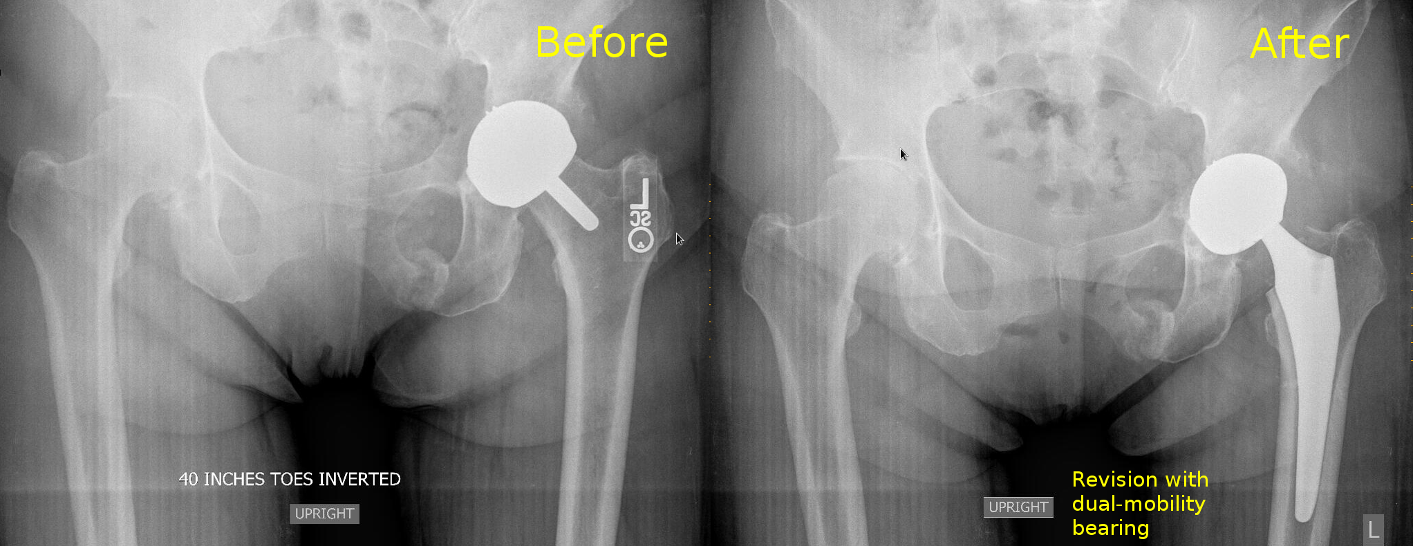 Revised Birmingham hip replacement