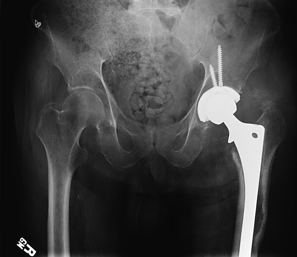 Successful hip infection treatment at 3 years