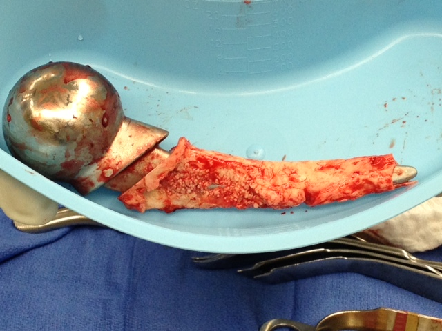 Removed hip implant