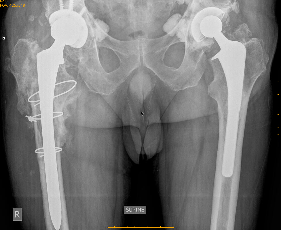 Revision of old cemented hip prosthesis, xrays at 6 months